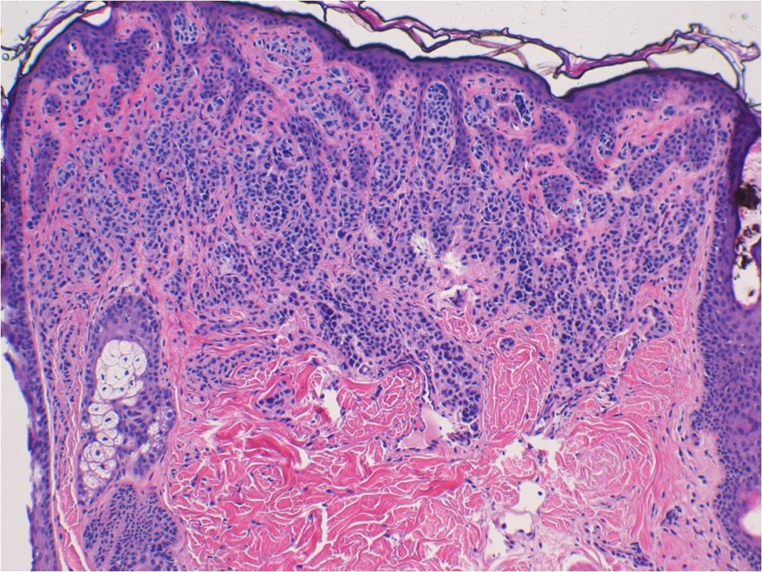 Figure 5. H&E section, Right parietal scalp, compound nevus with congenital pattern, 4x